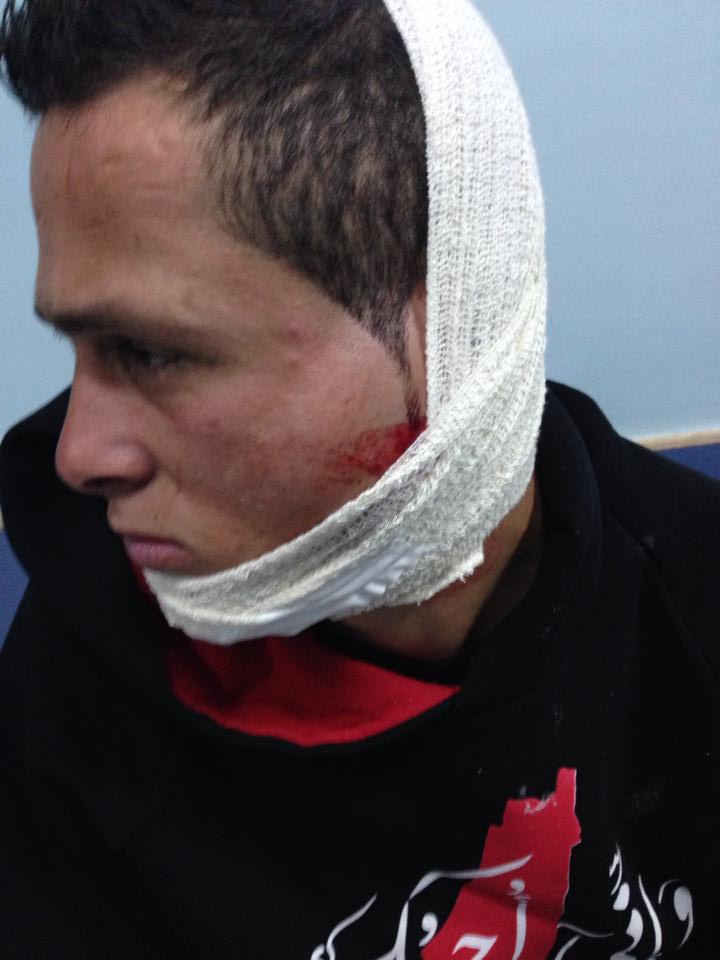 odai (21) in ramallah hospital yesterday after he was shot in the face by a rubber-coated steel bullet